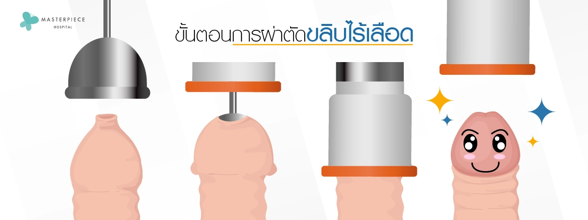 ขั้นตอนการทำหัตถการ